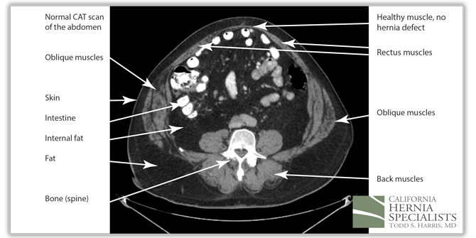 Recurrent Ventral Hernia CT Image